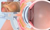 眼睛机理动画：三维医学动画制作、医学演示动画制作